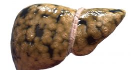 A Bigger Threat to Your Liver Than Alcohol