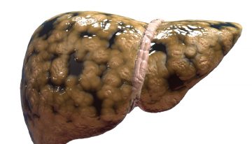 A Bigger Threat to Your Liver Than Alcohol